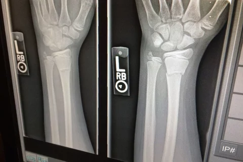 Wrist X-ray