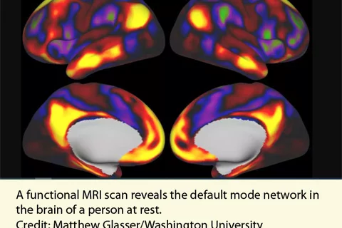 MRI scan