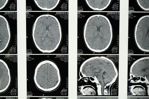 Medical Imaging of the Brain