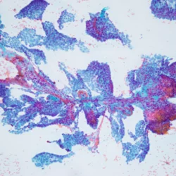 Anatomic Pathology Fine Needle Aspiration of Papillary Thyroid Carcinoma Lymph Node