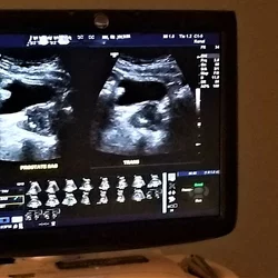 Kidney stones ultrasound