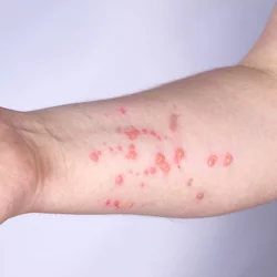 Monkeypox Treatment