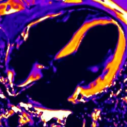 Cardiac MRI