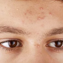 UCLA Researchers Identify Previously Unobserved Type of White Blood Cell Involved in Development of Pimples