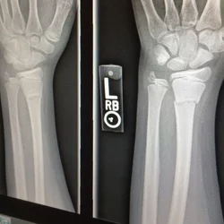 Wrist X-ray