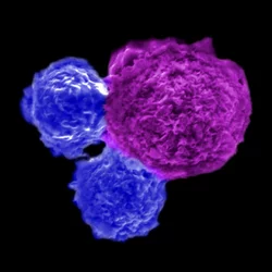 Blue iNKT cells attack a blood cancer cell